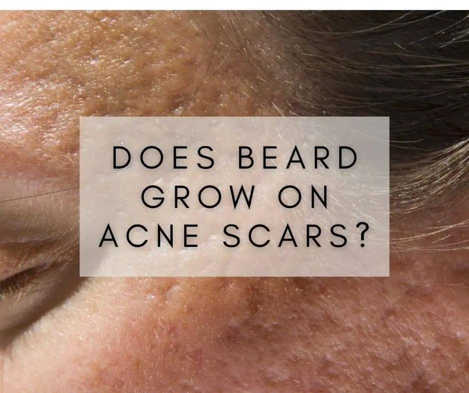 Does beard grow on acne scars?